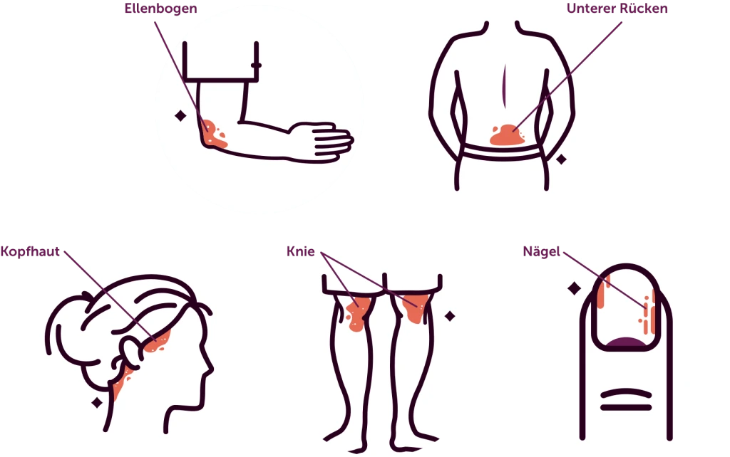 Illustration der haeufig betroffenen Koerperstellen bei Psoriasis (Schuppenflechte): Ellenbogen, unterer Rücken, Kopfhaut, Knie und Naegel. Jede Koerperregion ist mit einer schematischen Darstellung und markierten Hautveraenderungen (roetliche, schuppige Flecken) gekennzeichnet