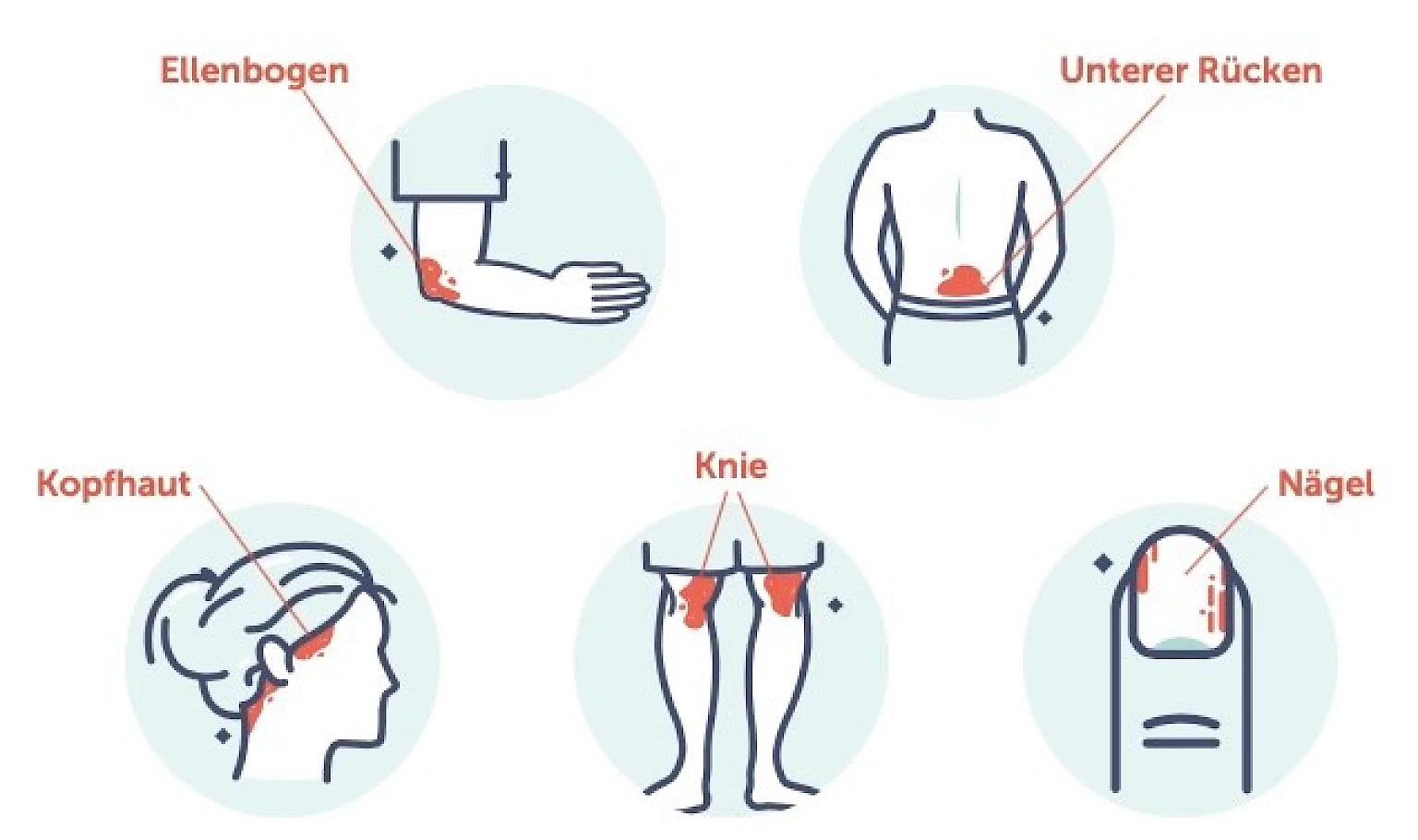 Illustration der haeufig betroffenen Koerperstellen bei Psoriasis (Schuppenflechte): Ellenbogen, unterer Rücken, Kopfhaut, Knie und Naegel. Jede Koerperregion ist mit einer schematischen Darstellung und markierten Hautveraenderungen (roetliche, schuppige Flecken) gekennzeichnet